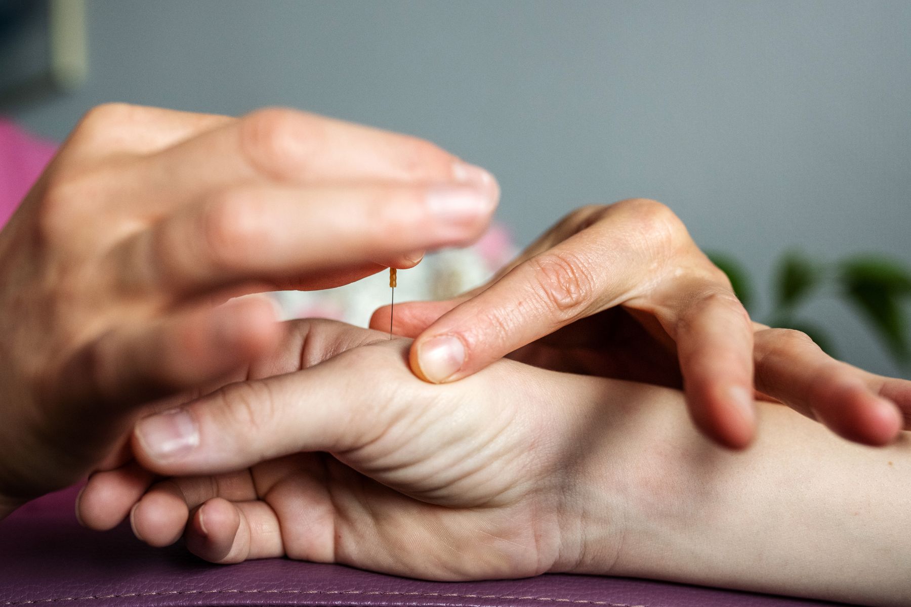 Acupuncture16